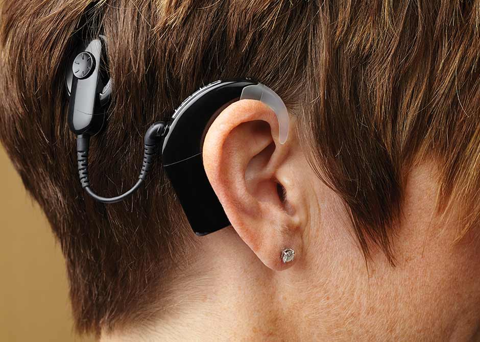 cochlear implant